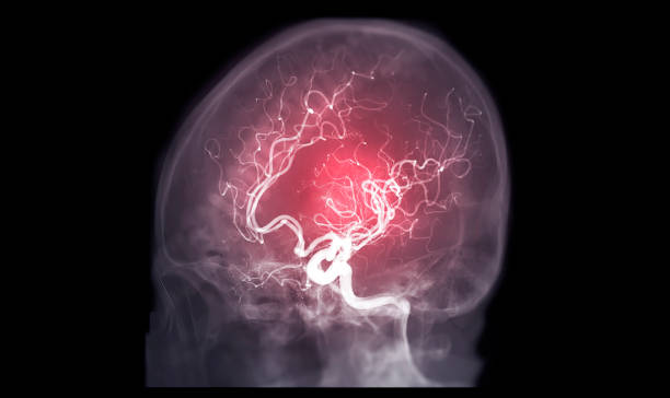 Cerebral angiography AP,Oblique and Lateral  view image from Fluoroscopy in intervention radiology  showing cerebral artery. Cerebral angiography AP,Oblique and Lateral  view image from Fluoroscopy in intervention radiology  showing cerebral artery. arterioles photos stock pictures, royalty-free photos & images