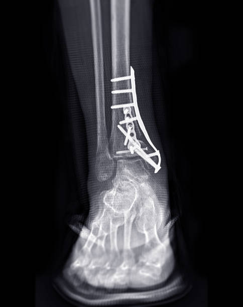プレートとネジによる内部固定による外科的処置を示す足首関節のx線画像。 - orthopedic equipment osteoporosis x ray human spine ストックフォトと画像