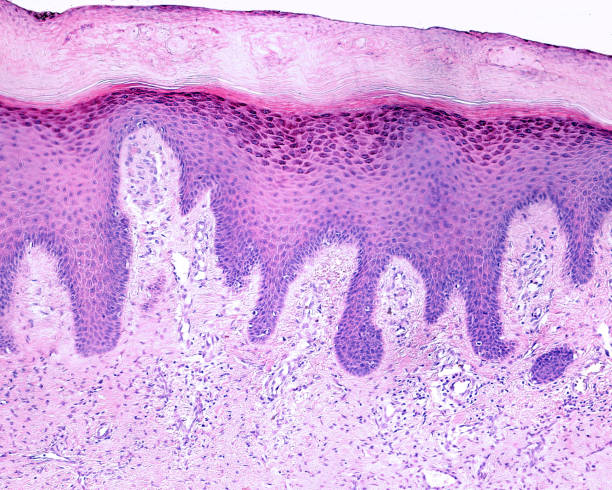 piel humana. hiperqueratosis y acantosis - human tissue histology dermatology human skin fotografías e imágenes de stock