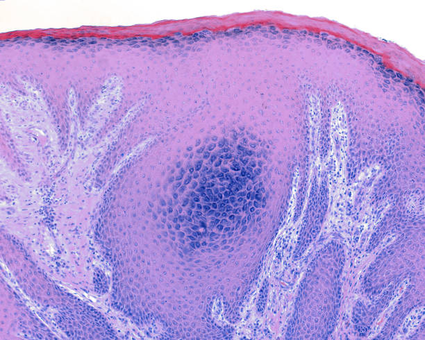 istock Human HPV papilloma 1349445455