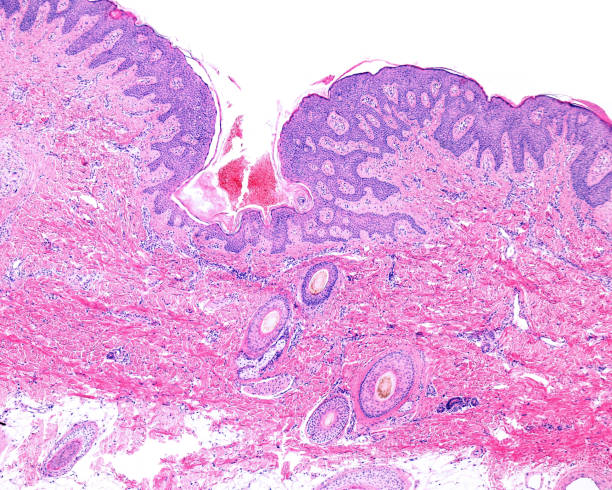istock Human scalp skin. Papilloma 1349456306