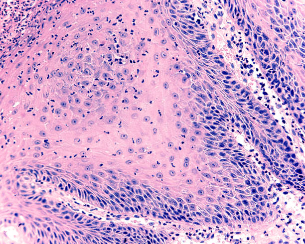 istock Human soft palate papilloma 1349456389