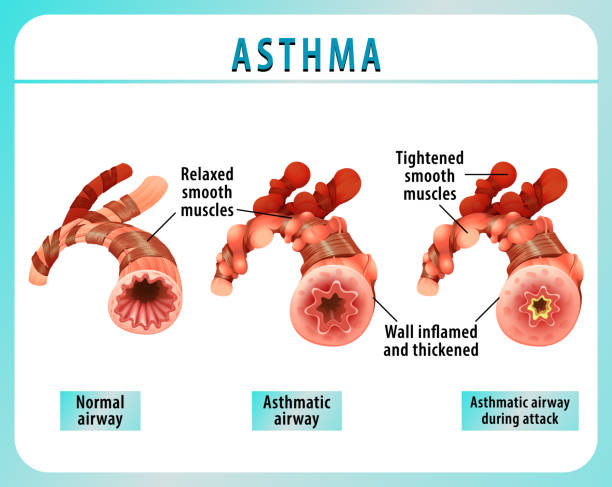 Bronchial Asthma diagram with normal airway and asthmatic airway Bronchial Asthma diagram with normal airway and asthmatic airway illustration clip art of a diagram of human lungs stock illustrations