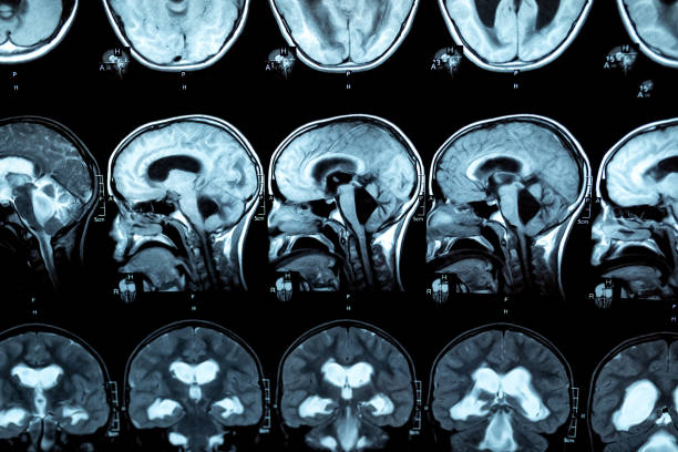 MRI scan or magnetic resonance image of the brain showed obstructive triventricular hydrocephalus with clinical of hydrocephalus, cognitive decline, incontinence. Neurology, medical service concept. MRI scan or magnetic resonance image of the brain showed obstructive triventricular hydrocephalus with clinical of hydrocephalus: cognitive decline, incontinence. Neurology, medical service concept. medical research photos stock pictures, royalty-free photos & images
