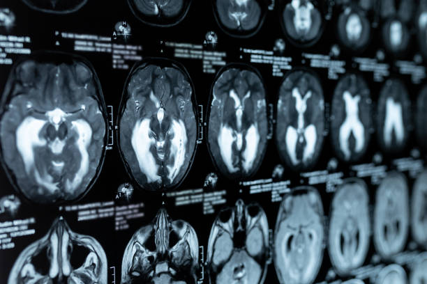 istock MRI scan or magnetic resonance image of the brain showed obstructive triventricular hydrocephalus. Medical service concept. 1349972467