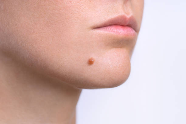 Mole on face. Young woman face with birthmark or nevus. Copy space Mole on face. Young woman face with birthmark or nevus. Copy space. High quality photo mole stock pictures, royalty-free photos & images