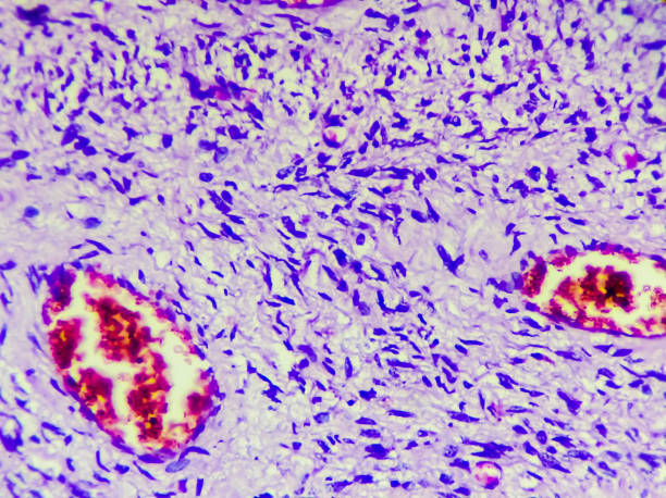 istock Photomicrograph (microscopic image) from breast mastectomy specimen showing phyllodes tumor (cystosarcoma phylodes), leaf like benign glandular elements seen 1350233022
