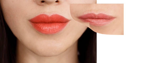 istock girl lips before and after augmentation 1350240449