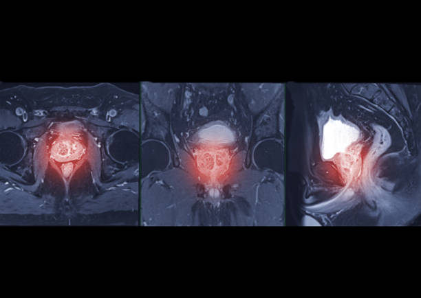 comparaison de l’irm de la prostate axiale, coronale et sagittale t2w pour le diagnostic de la cellule cancéreuse de la prostate chez les hommes âgés. - prostate gland photos et images de collection