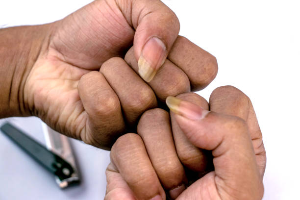 istock A human showing his big and dirty nails on white background 1350400217