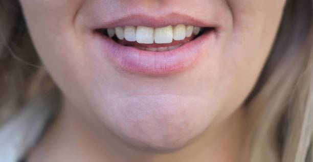 istock Woman's smile after dental treatment. Tooth augmentation. Veneers. Close-up. 1350406881