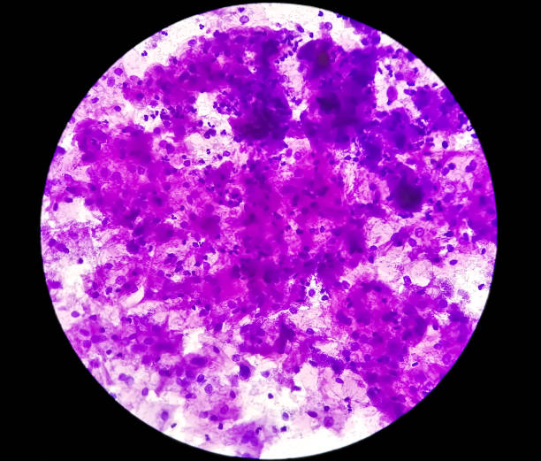 istock View in microscopic of human cervix cells. Squamous epithelial cells. Pap smear. pap's. cervical cancer diagnosis 1350412044