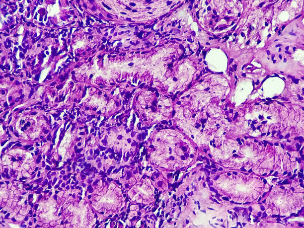 carcinoma de células escamosas de una muestra de tejido humano imagen microscópica. - laboratory healthcare and medicine cancer drug histology fotografías e imágenes de stock