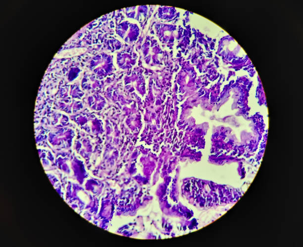 istock Squamous cell carcinoma of a human tissue specimen microscopic image. 1350447783