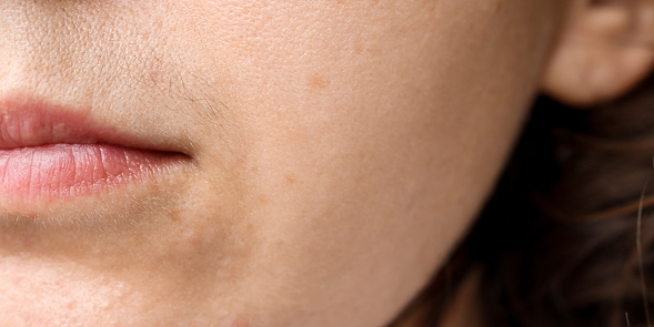 Close-up of a woman's face with a black mustache above the upper lip. Problematic skin, improper care and hirsutism