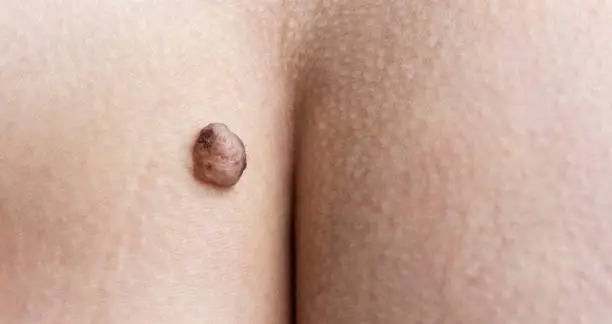 Large moles on body parts, buttock. Concept Deleting Molenia Laser Self or Surgical