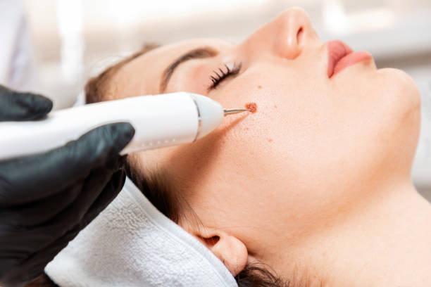 Professional salon procedures. Surgeon using a laser device for removing mole. Removal of birthmark from female face. Close up. Concept of laser cosmelotogy and electrocoagulation Professional salon procedures. Surgeon using a laser device for removing mole. Removal of birthmark from female face. Close up. Concept of laser cosmelotogy and electrocoagulation. mole stock pictures, royalty-free photos & images