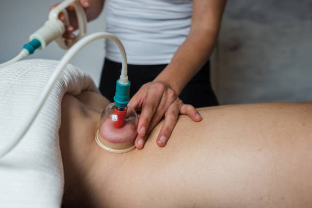 istock Masseuse applying vacuum cup on loin of client 1350600975