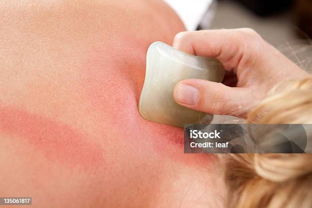 Vermelhidão Durante Gua Sha - Fotografias de stock e mais imagens de Gua sha - Gua sha, Massajar, Corpo humano