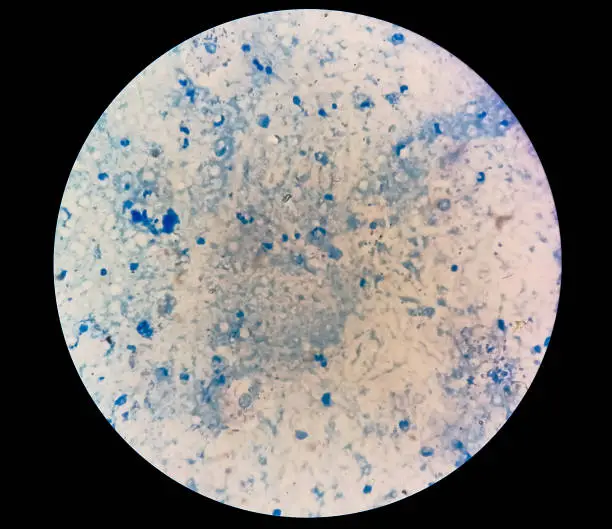 Photo of Sputum smear under microscopy showing gram positive cocci bacteria. Smear of Gram's stained from sputum specimen