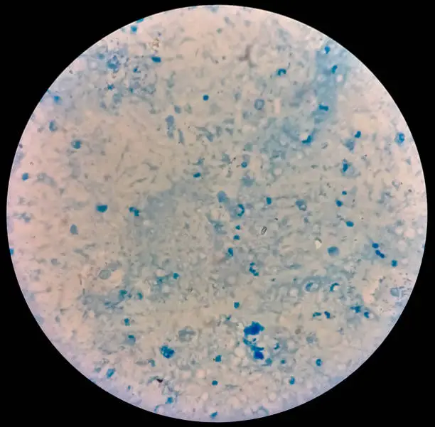 Photo of Sputum smear under microscopy showing gram positive cocci bacteria. Smear of Gram's stained from sputum specimen