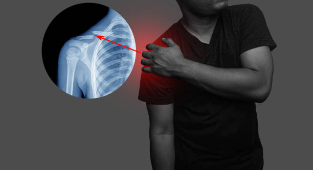 close up shoulder and clavicle fracture pain in a man, young man holding his shoulder in pain shoulder inflammation symptoms medical healthcare concept. - clavicle imagens e fotografias de stock