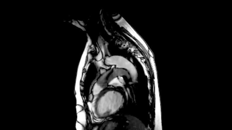 MRI heart or Cardiac MRI or magnetic resonance imaging of heart compare RVOT and LVOT for diagnosis heart disease.