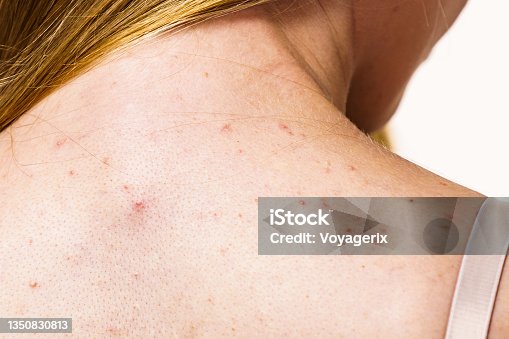 istock Woman with skin problem acne on back 1350830813