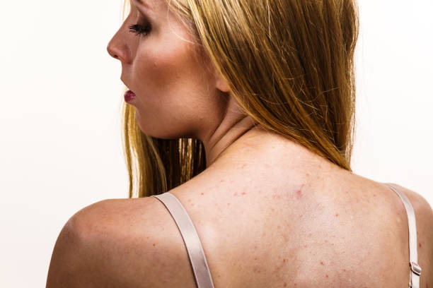 istock Woman with skin problem acne on back 1350831654