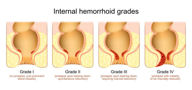 stopnie hemoroidów - hemorrhoid stock illustrations