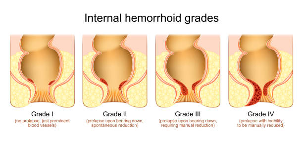 hemorrhoid grades hemorrhoid grades. Stage of Internal piles, degree of vascular prolapse in the anal canal. Vector illustration sphincter stock illustrations
