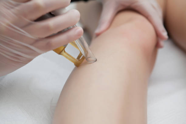 istock Laser hair removal 1350937273