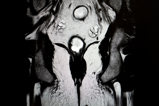 Computed MRI image of Prostate Cancer.