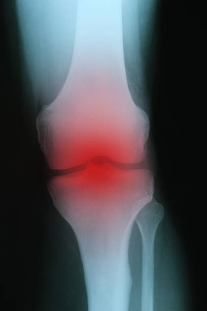 istock X ray with red inflammation of knee joint closeup 1351042212
