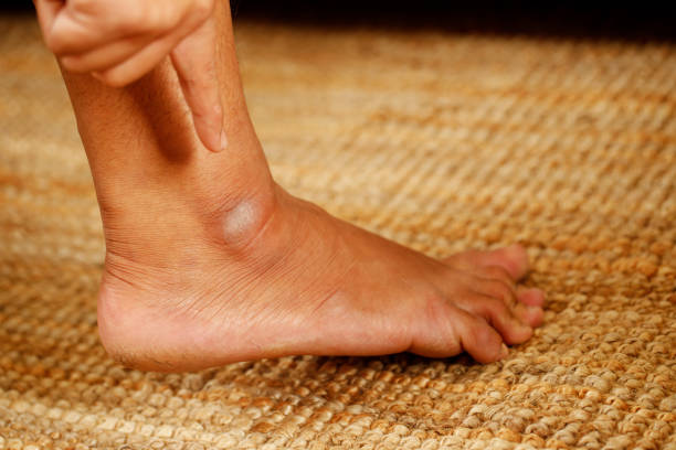 istock cracked heel treatment The foot cream should be applied regularly. 1351057851