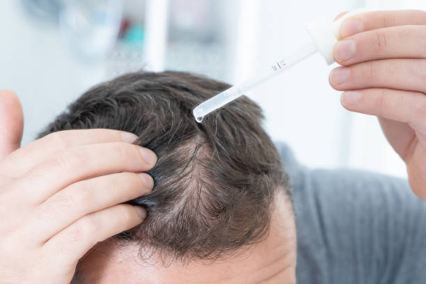 istock Man doing hair loss treatment as morning routine 1351071684