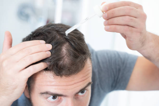 istock Man using hair loss treatment on his scalp 1351071715
