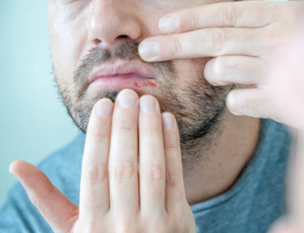 istock Man suffering for herpes simplex on the lips 1351071736