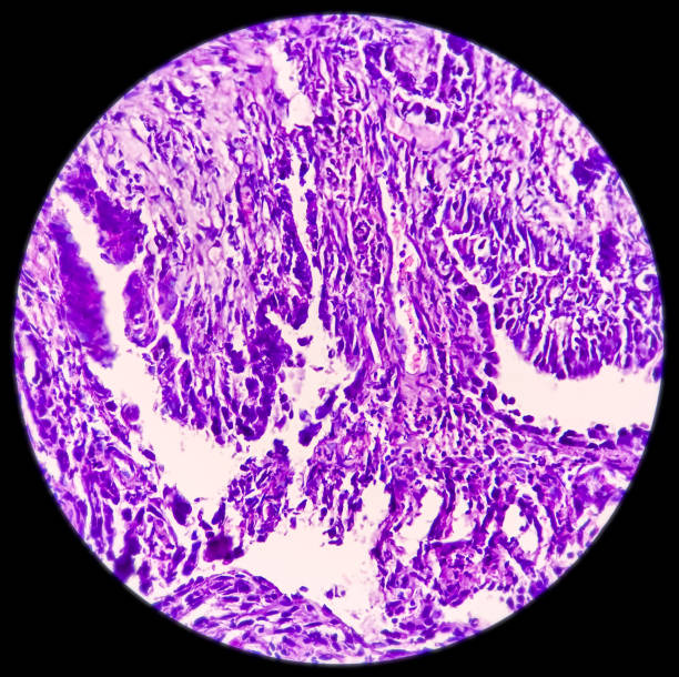 Colon Cancer: Photomicrograph (microscopic image) of colorectum adenocarcinoma,Light microscope 40x showing rectum adenocarcinoma Colon Cancer: Photomicrograph (microscopic image) of colorectum adenocarcinoma,Light microscope 40x showing rectum adenocarcinoma squamous cell carcinoma photos stock pictures, royalty-free photos & images