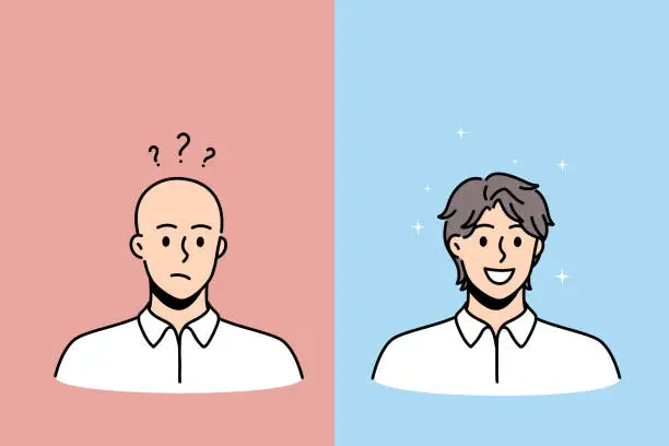 Vector illustration of Hair loss and baldness concept