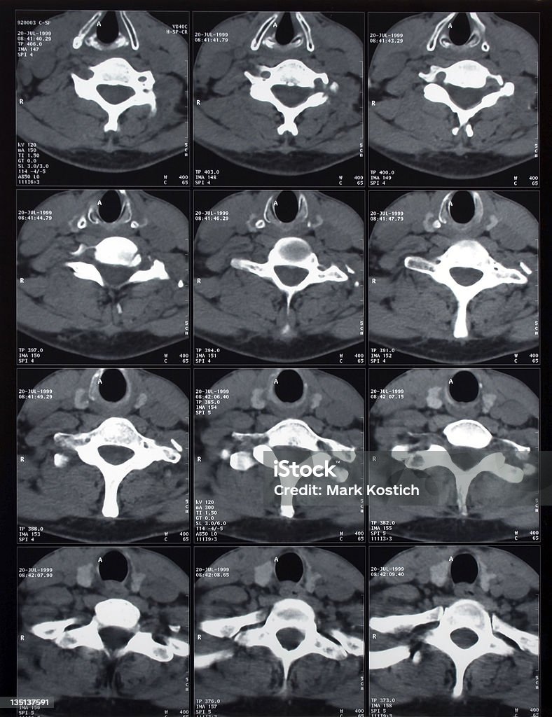 Tomografia computerizzata a raggi X delle lesioni al collo immagine - Foto stock royalty-free di Anatomia umana
