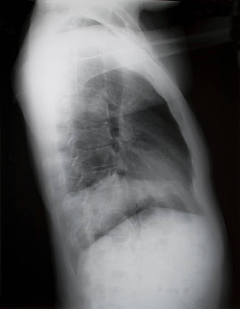 ラテラル・肺、胸 x 線 - human lung tuberculosis bacterium emphysema human trachea ストックフォトと画像