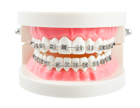 Teeth model wire dental braces isolated on white background, save clipping path.