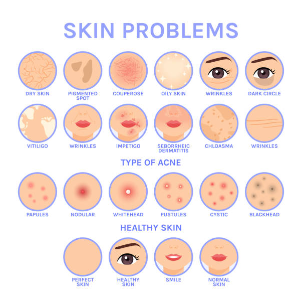 Skin Problems. Set of Icons for Different Skin Diseases of Face. Before After. Healthy Perfect Clean skin. Illustration for Medical and Cosmetic Design. White background. Flat Cartoon style. Vector. Skin Problems. Set of Icons for Different Skin Diseases of Face. Before After. Healthy Perfect Clean skin. Illustration for Medical and Cosmetic Design. White background. Flat Cartoon style. Vector. vitiligo stock illustrations