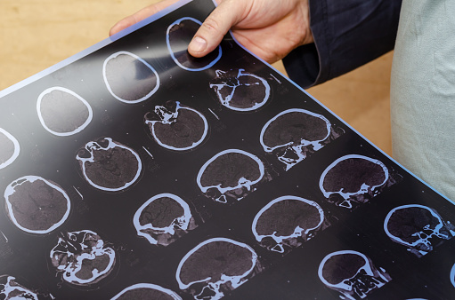 Hombre adulto sosteniendo una tomografía computarizada del cerebro. Examen de un pati photo