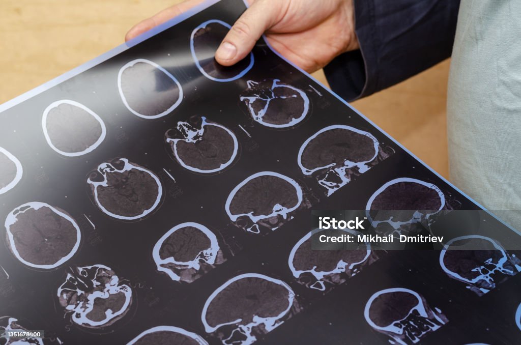 Adult male holding a CT scan of the brain. Examination of a pati Adult male holding a CT scan of the brain. Examination of a patient in the radiology department at a hospital. Traffic accident, concussion. Selective focus. Shock Stock Photo