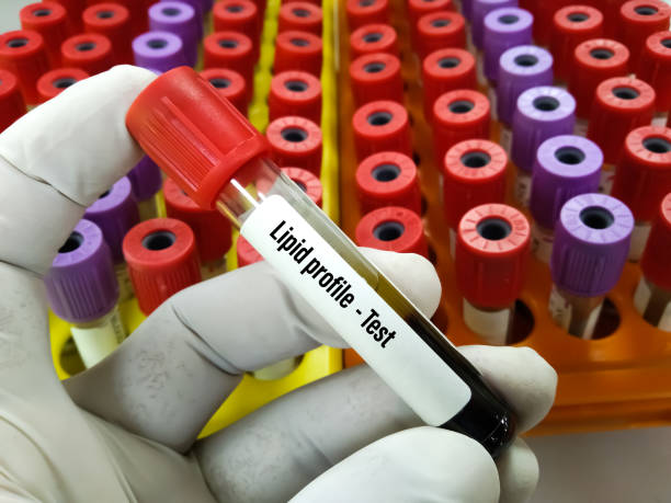 Lipid profile test at medical laboratory. Blood sample tube for Lipid profile test. To diagnosis cardiac function at medical laboratory. cholesterol screening stock pictures, royalty-free photos & images