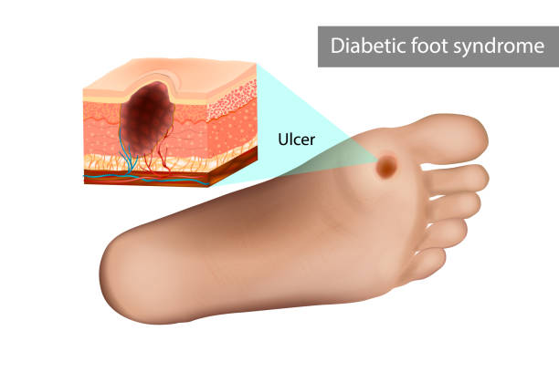 illustrazioni stock, clip art, cartoni animati e icone di tendenza di ulcera da sindrome del piede diabetico. distruzione dei tessuti profondi del piede - deformato