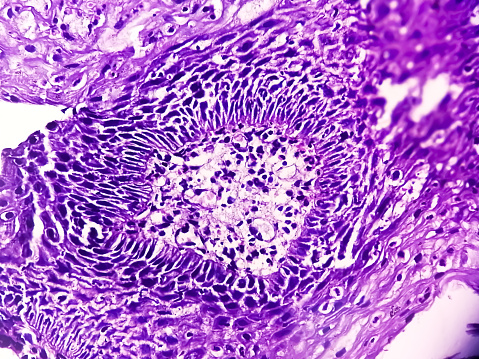 Microscopic close view of Adenocarcinoma of the colon. Colon cancer. colorectal cancer.