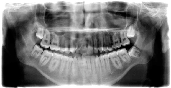 Dental X-Ray of mouth showing jaw and teeth - 32 teeth without dental filling